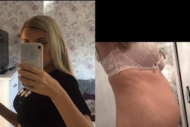 Before and after surgery (left): Endometriosis was causing Lucy's stomach to become bloated.