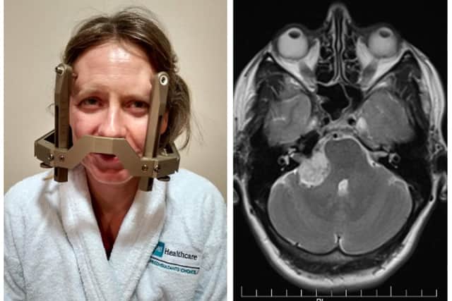 Left: Liz ready for Gamma Knife treatment. Right: Liz's diagnosis MRI. Images: The Kirtley family.